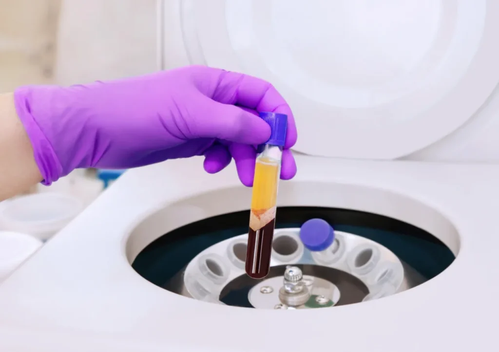 Platelet-rich plasma (PRP)